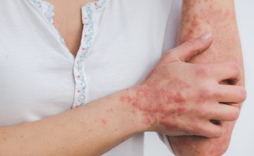 psoriasis 5996424 1280 e1682946767215