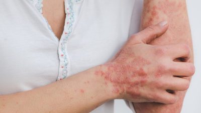 psoriasis 5996424 1280 e1682946767215