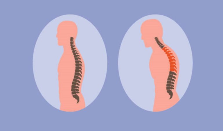 Mengenal Penyakit Kifosis: Salah Satu Kelainan Pada Tulang Belakang