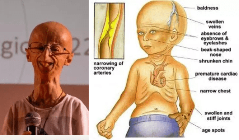 Sammy Basso; Penyintas Progeria Terlama Tutup Usia, Kenali Penyakitnya!