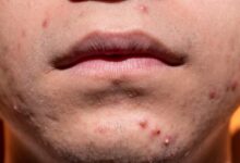 acne 6822174 1280 e1760367275479