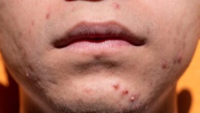 acne 6822174 1280 e1760367275479