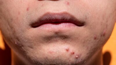 acne 6822174 1280 e1760367275479